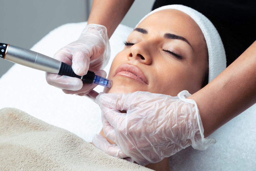 Get Microneedling Prices in Tysons Corner Here!