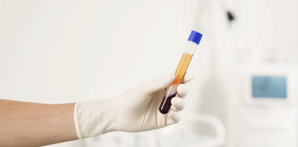 platelet rich fibrin