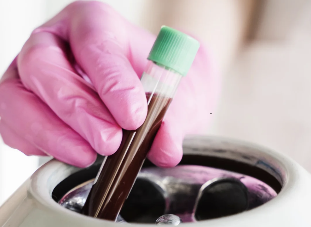 platelet-rich fibrin