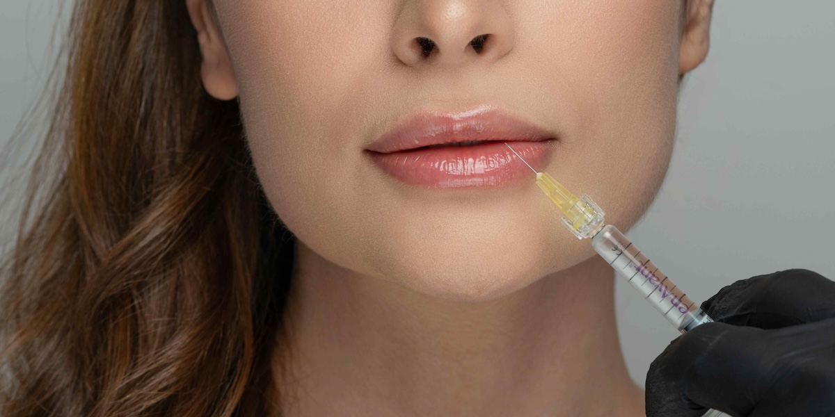 Dermal Filler Appointments for Lips and Cheeks in Vienna VA