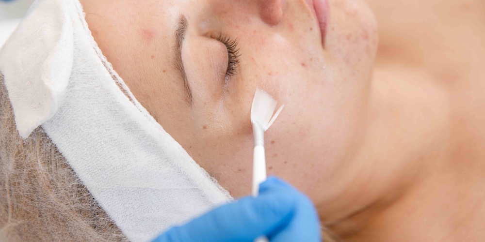 Chemical Peels for Melasma in McLean VA