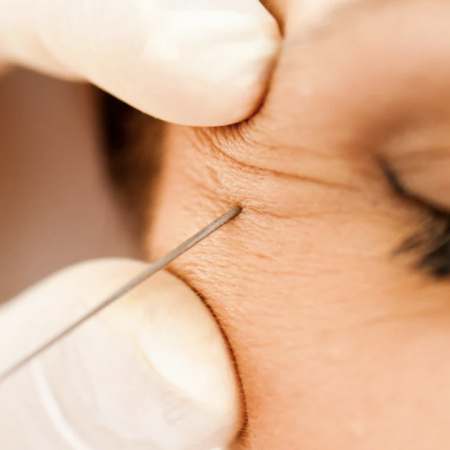 dysport wrinkle reduction